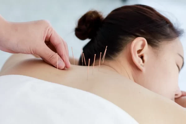 5 Things You Should Know Before Trying Acupuncture!