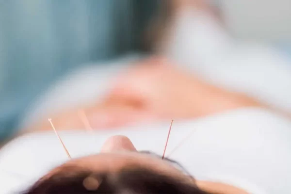 Acupuncture for Anxiety